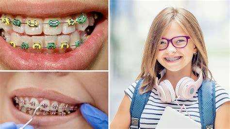 todo sobre los brackets metalicos|que son brackets metalicos.